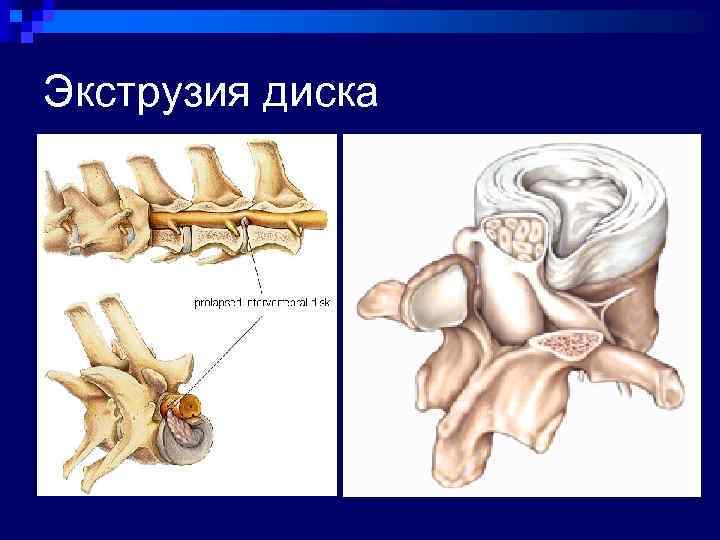 Экструзии дисков позвоночника шейного отдела