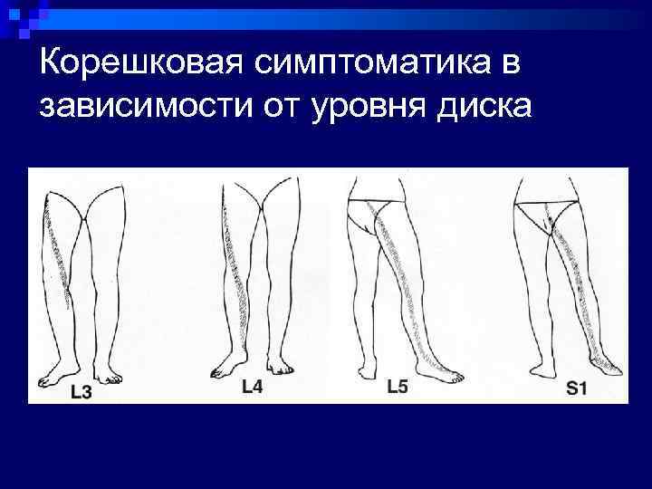 Корешковая симптоматика в зависимости от уровня диска 