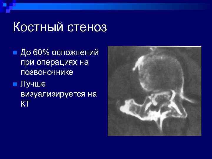 Костный стеноз n n До 60% осложнений при операциях на позвоночнике Лучше визуализируется на
