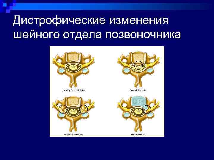 Дистрофические изменения позвоночника что это