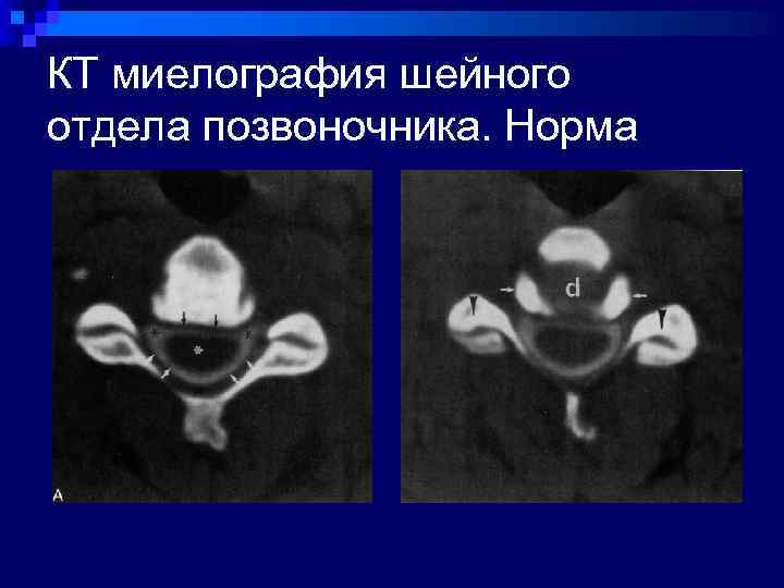 КТ миелография шейного отдела позвоночника. Норма 