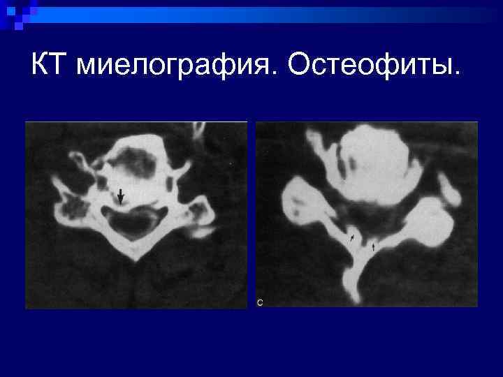 КТ миелография. Остеофиты. 