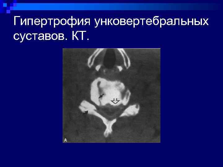 Гипертрофия унковертебральных суставов. КТ. 