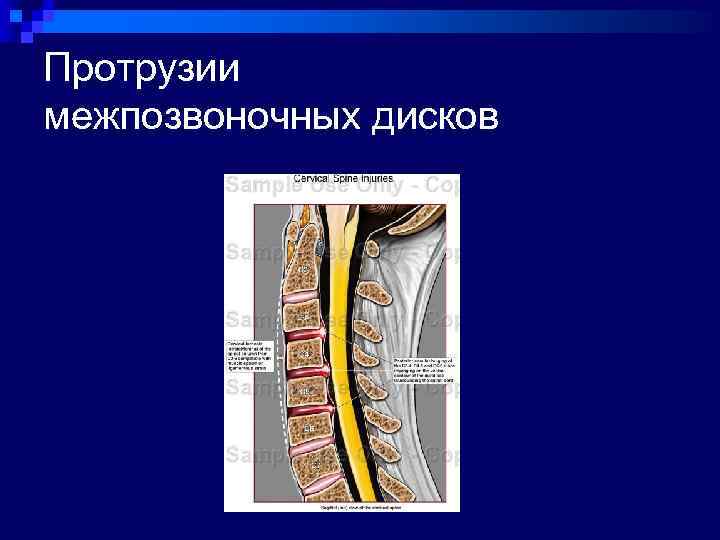 Протрузии межпозвоночных дисков 