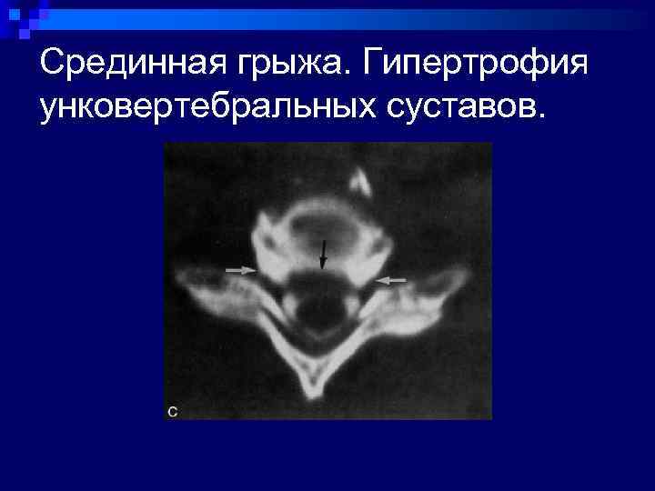 Срединная грыжа. Гипертрофия унковертебральных суставов. 