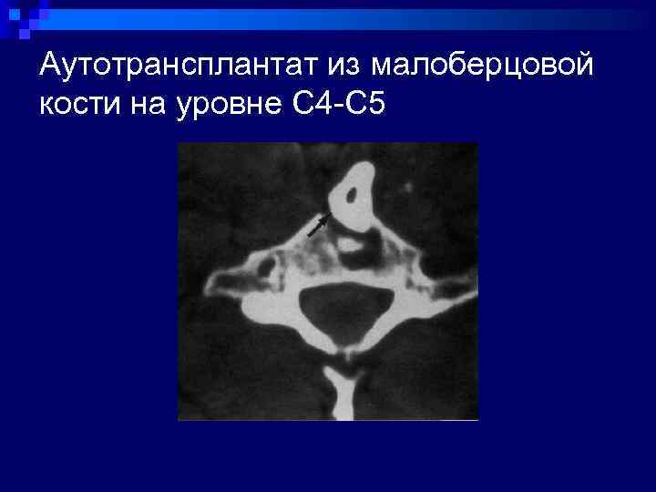 Аутотрансплантат из малоберцовой кости на уровне С 4 -С 5 