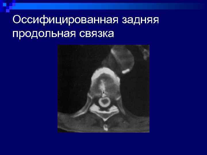 Оссифицированная задняя продольная связка 
