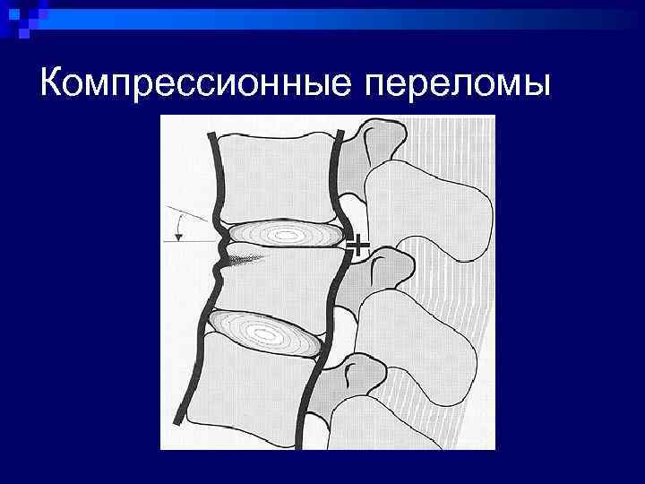 Компрессионные переломы 
