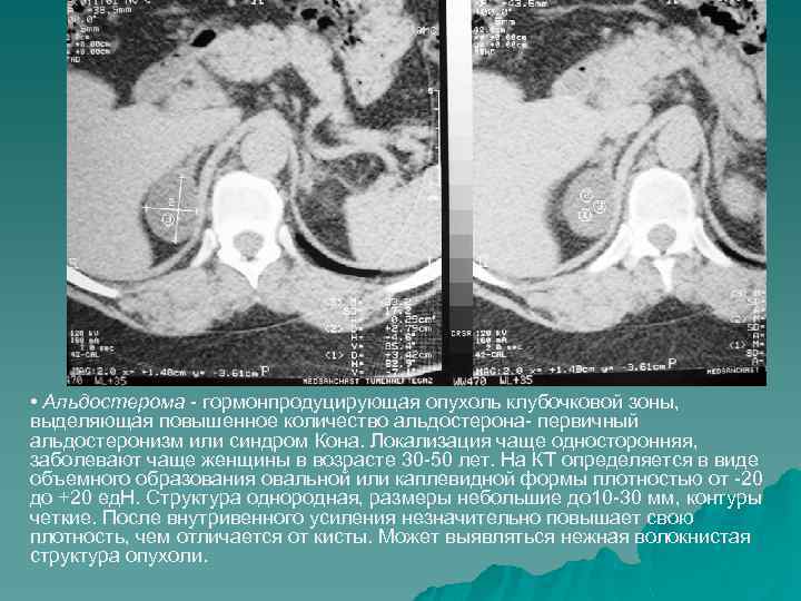  • Альдостерома - гормонпродуцирующая опухоль клубочковой зоны, выделяющая повышенное количество альдостерона- первичный альдостеронизм