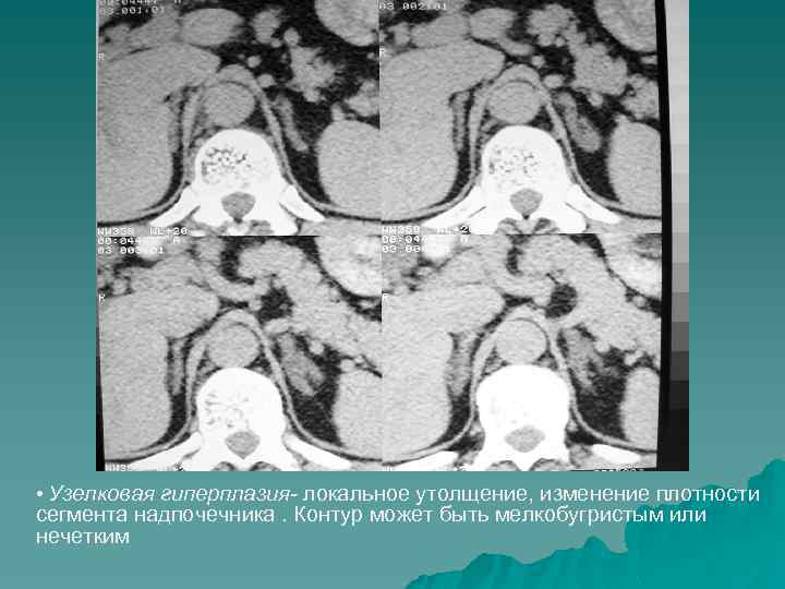  • Узелковая гиперплазия- локальное утолщение, изменение плотности сегмента надпочечника. Контур может быть мелкобугристым