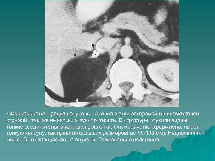  • Миелолипома – редкая опухоль. Сходна с альдостеромой и липоматозной струмой , так