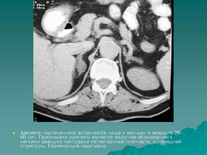 u Аденома надпочечника встречается чаще у женщин в возрасте 2060 лет. Признаками аденомы является