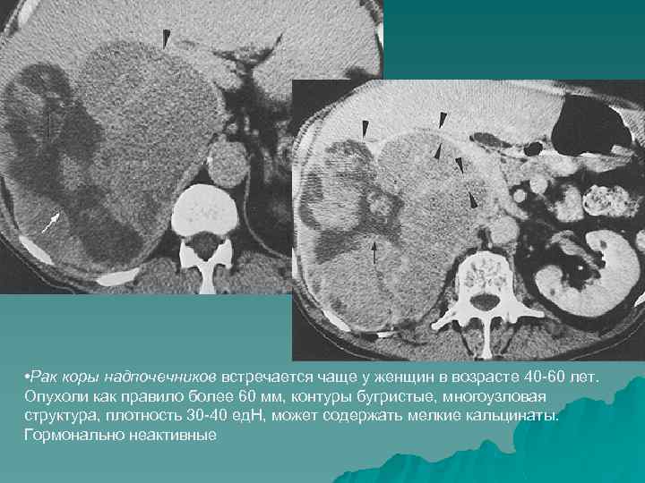 КТ и МР диагностика заболеваний надпочечников 1Нормальная