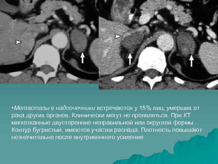  • Метастазы в надпочечники встречаются у 15% лиц, умерших от рака других органов.