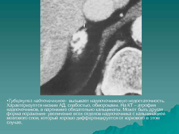  • Туберкулез надпочечников- вызывает надпочечниковую недостаточность. Характеризуется низким АД, слабостью, обмороками. На КТ