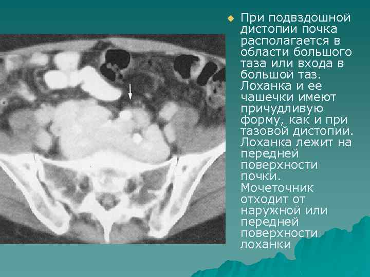 u При подвздошной дистопии почка располагается в области большого таза или входа в большой