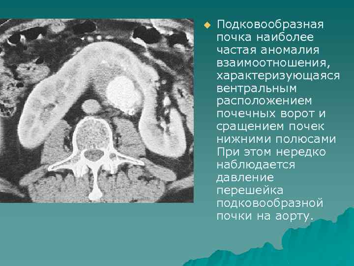 u Подковообразная почка наиболее частая аномалия взаимоотношения, характеризующаяся вентральным расположением почечных ворот и сращением