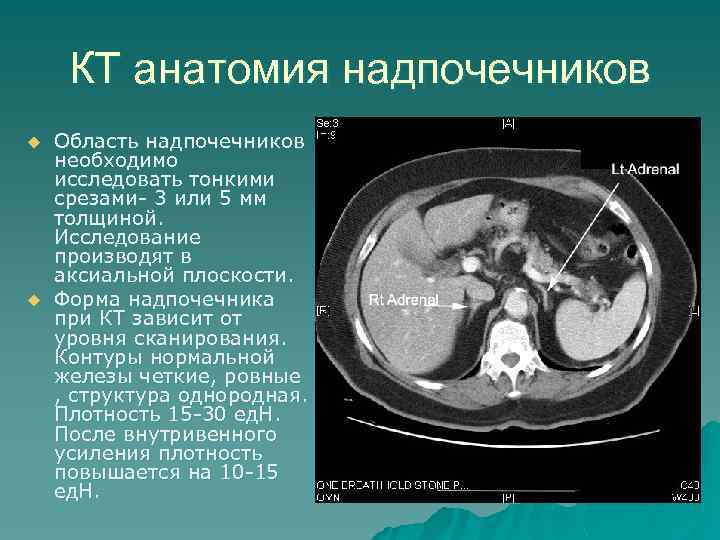 КТ анатомия надпочечников u u Область надпочечников необходимо исследовать тонкими срезами- 3 или 5