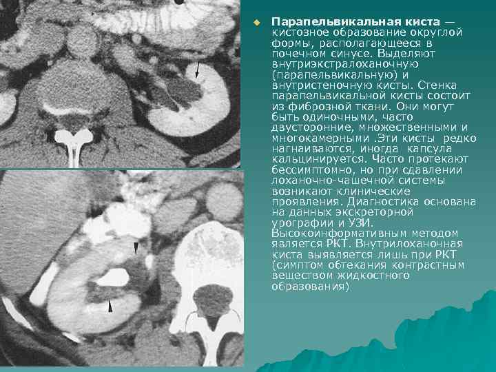 u Парапельвикальная киста — кистозное образование округлой формы, располагающееся в почечном синусе. Выделяют внутриэкстралоханочную