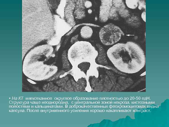  • На КТ мягкотканное округлое образование плотностью до 20 -50 ед. Н. Структура