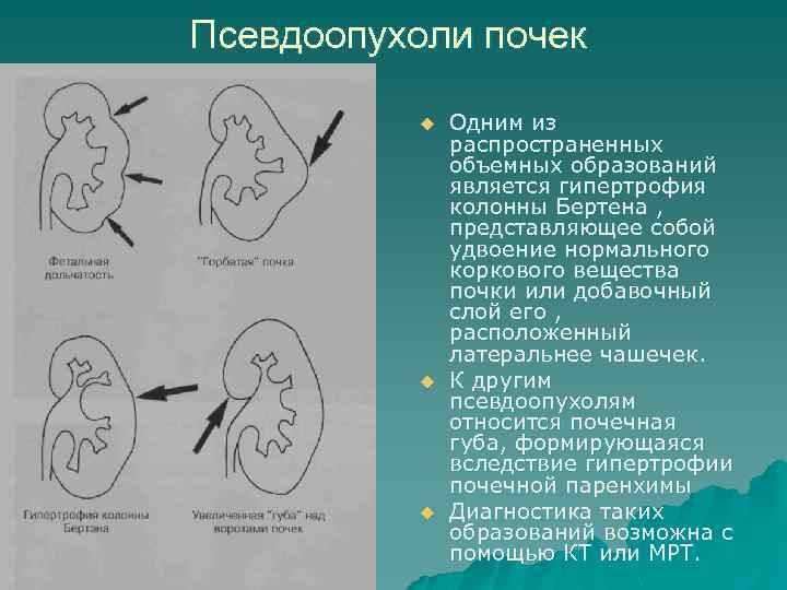 Псевдоопухоли почек u u u Одним из распространенных объемных образований является гипертрофия колонны Бертена