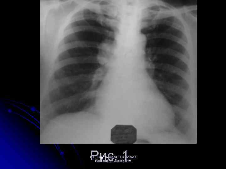 Рис. 1 Н. С. Воротынцева. С. С. Гольев Рентгенопульмонология 