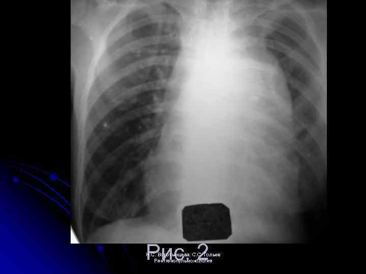 Рис. 2 Н. С. Воротынцева. С. С. Гольев Рентгенопульмонология 