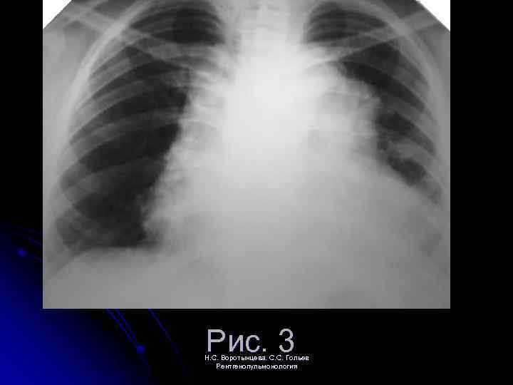 Рис. 3 Н. С. Воротынцева. С. С. Гольев Рентгенопульмонология 