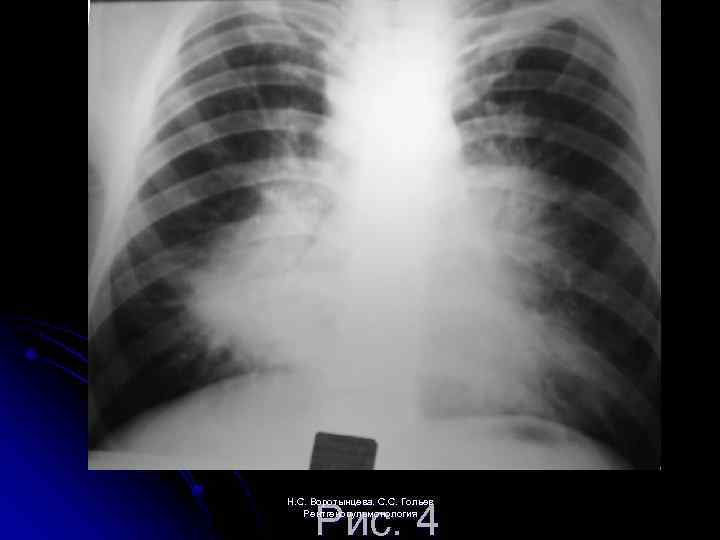 Рис. 4 Н. С. Воротынцева. С. С. Гольев Рентгенопульмонология 