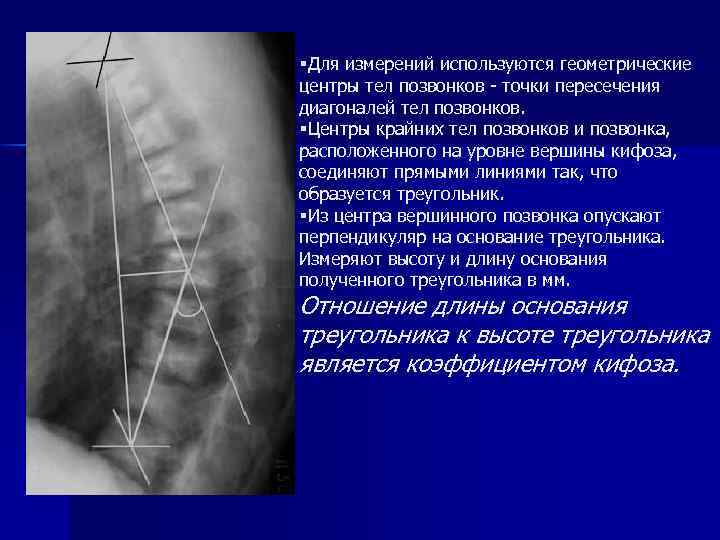 §Для измерений используются геометрические центры тел позвонков - точки пересечения диагоналей тел позвонков. §Центры