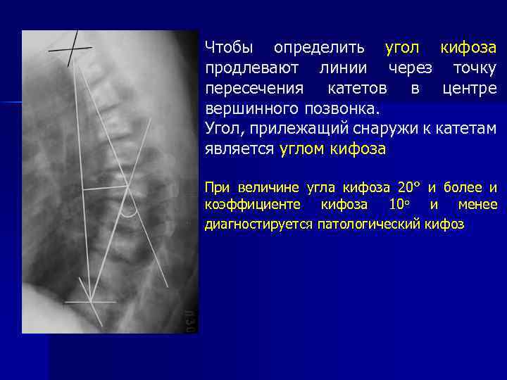 Чтобы определить угол кифоза продлевают линии через точку пересечения катетов в центре вершинного позвонка.