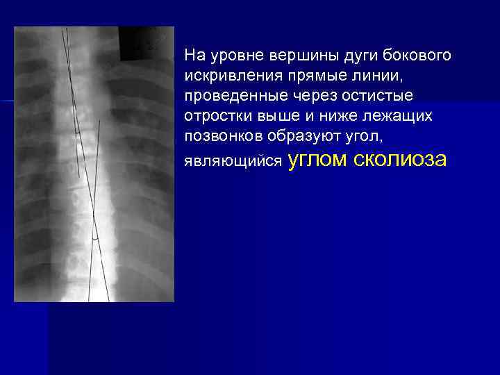 На уровне вершины дуги бокового искривления прямые линии, проведенные через остистые отростки выше и