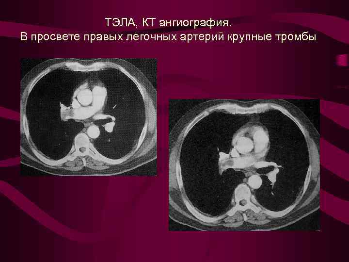 ТЭЛА, КТ ангиография. В просвете правых легочных артерий крупные тромбы 