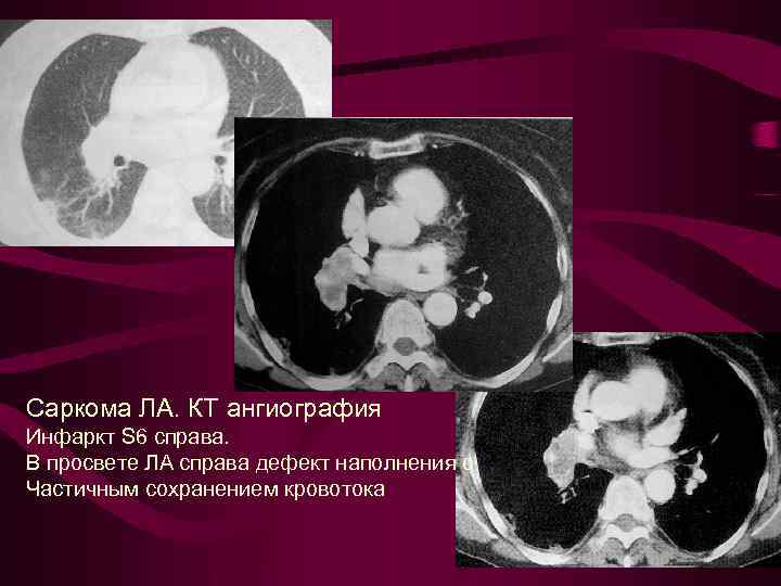 Саркома ЛА. КТ ангиография Инфаркт S 6 справа. В просвете ЛА справа дефект наполнения