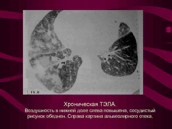 Хроническая ТЭЛА. Воздушность в нижней доле слева повышена, сосудистый рисунок обеднен. Справа картина альвеолярного