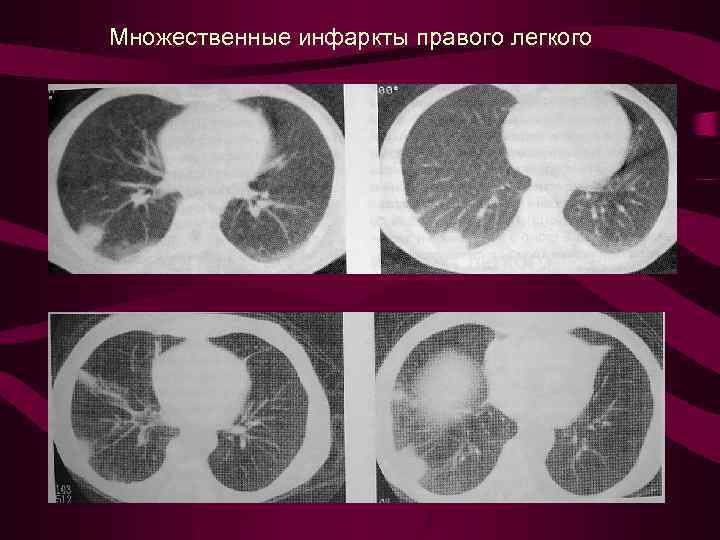 Множественные инфаркты правого легкого 