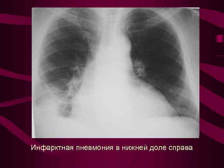 Инфарктная пневмония в нижней доле справа 