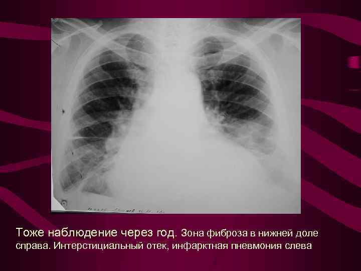 Пневмония в правом легком в нижней доле. Интерстициальный фиброз легких. Линейный фиброз рентген. Интерстициальный пневмофиброз. Линейный пневмофиброз s9.