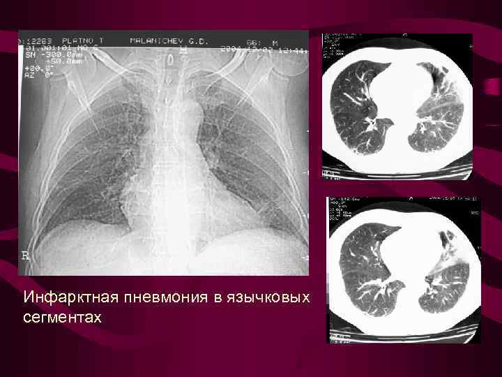 Инфарктная пневмония в язычковых сегментах 