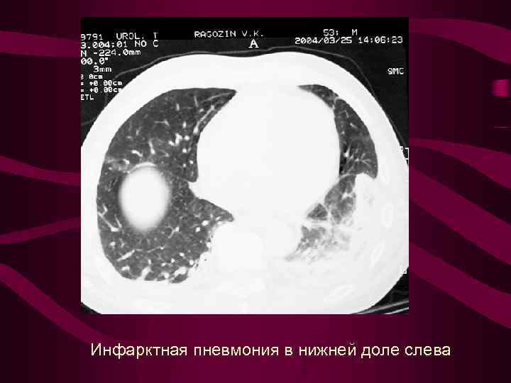 Инфарктная пневмония в нижней доле слева 