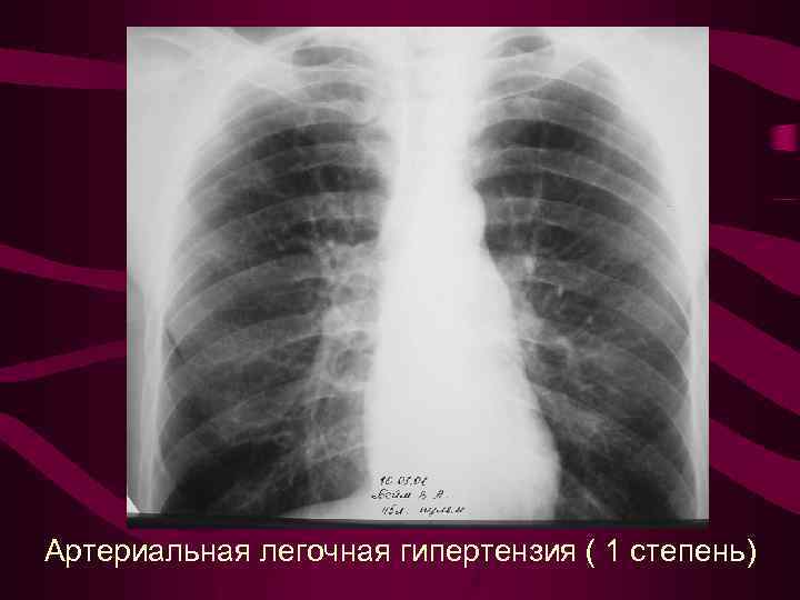 Артериальная легочная гипертензия ( 1 степень) 