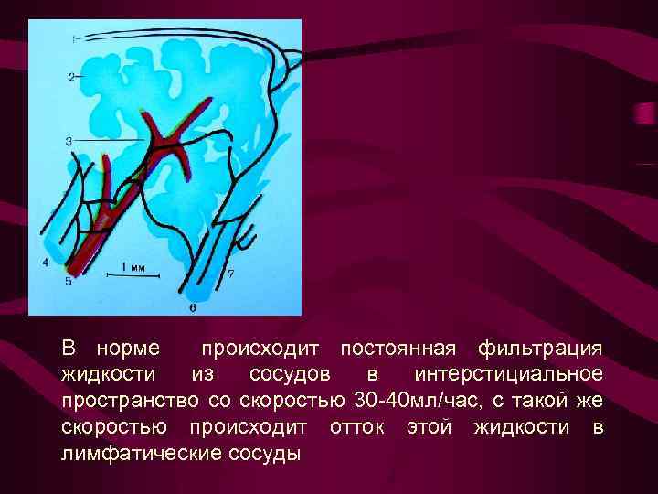 В норме происходит постоянная фильтрация жидкости из сосудов в интерстициальное пространство со скоростью 30
