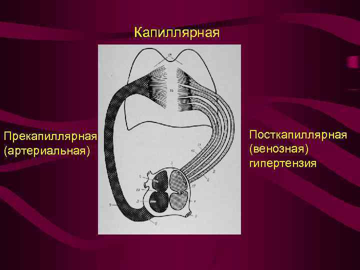 Капиллярная Прекапиллярная (артериальная) Посткапиллярная (венозная) гипертензия 