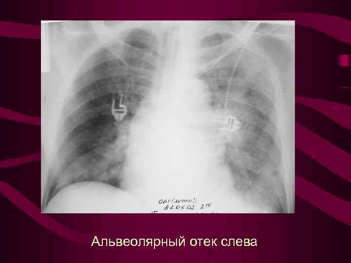 Альвеолярный отек слева 