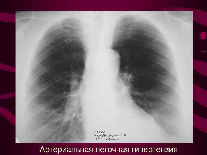 Артериальная легочная гипертензия 