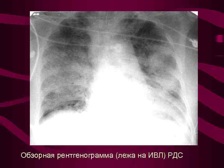 Обзорная рентгенограмма (лежа на ИВЛ) РДС 