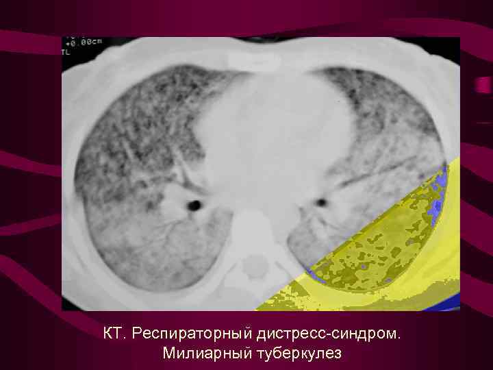 КТ. Респираторный дистресс-синдром. Милиарный туберкулез 