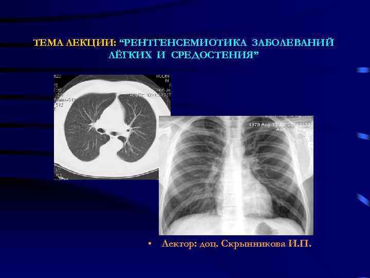 ТЕМА ЛЕКЦИИ: “РЕНТГЕНСЕМИОТИКА ЗАБОЛЕВАНИЙ ЛЁГКИХ И СРЕДОСТЕНИЯ” • Лектор: доц. Скрынникова И. П. 