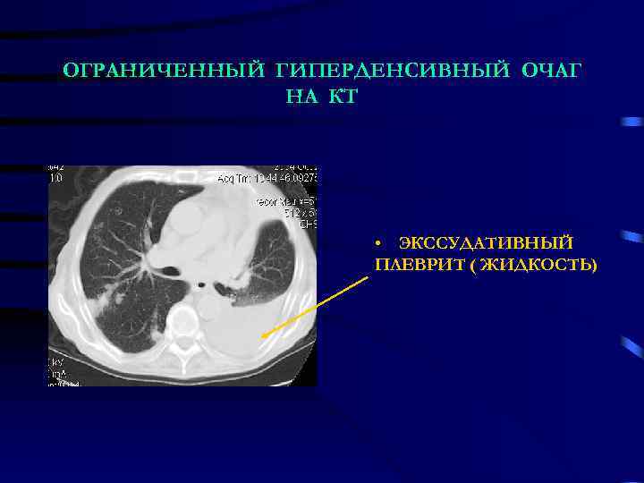 ОГРАНИЧЕННЫЙ ГИПЕРДЕНСИВНЫЙ ОЧАГ НА КТ • ЭКССУДАТИВНЫЙ ПЛЕВРИТ ( ЖИДКОСТЬ) 