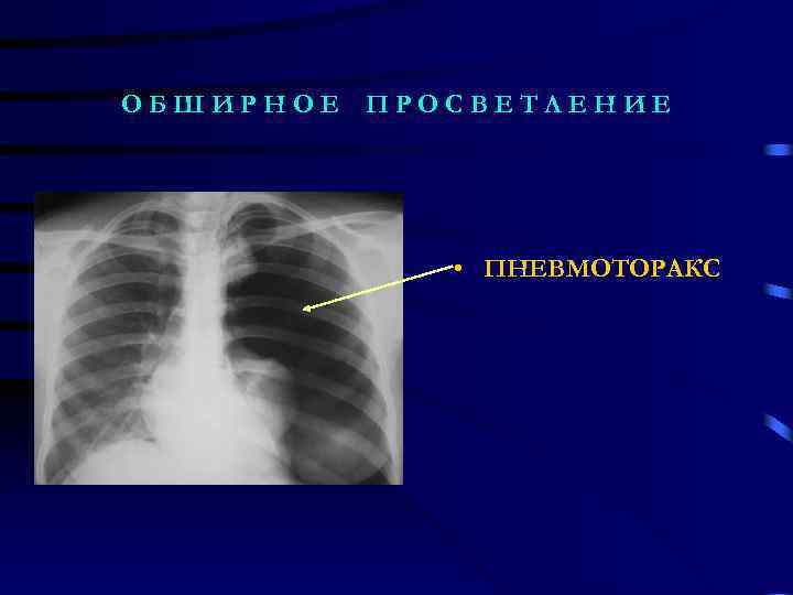 ОБШИРНОЕ ПРОСВЕТЛЕНИЕ • ПНЕВМОТОРАКС 